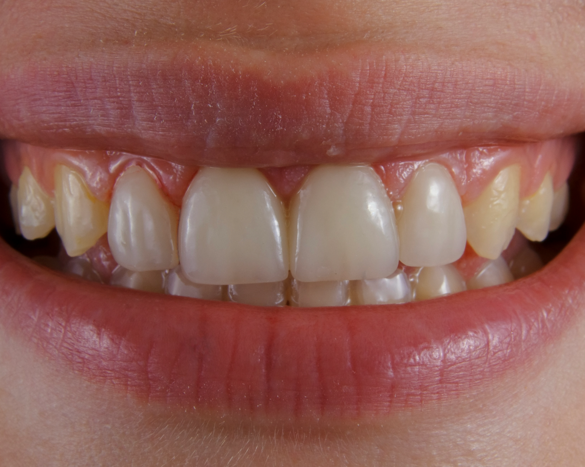Før SmileStrips
