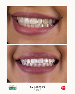 Whitening Strips
